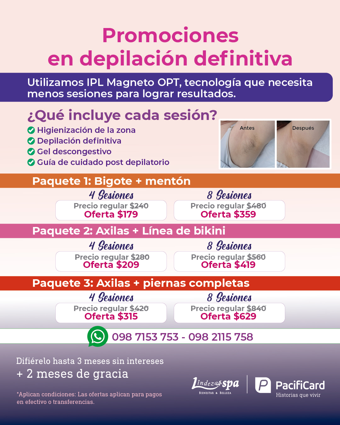 depilación definitiva, depilación de axilas, depilación luz pulsada intensa OPT, depilación laser, depilación en Guayaquil